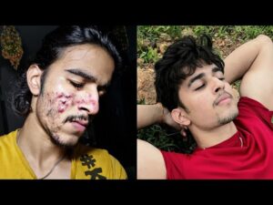 Full Acne Guide: Fix Your Pimples Permanently ( Video Guide - 30 min)